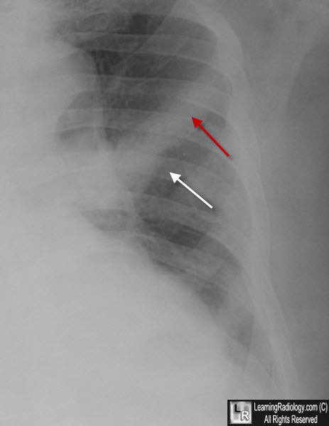 Metastatic Prostate Carcinoma to Rib